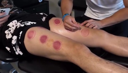 直播观看-曾凡博腿部接受干针疗法！网媒：曾凡博月底来布鲁克林和篮网会合